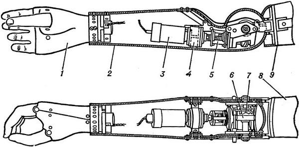 протез плеча