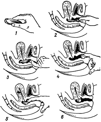 техніка надягання протизаплідного ковпачка