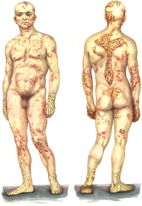 поширений псоріаз psoriasis vulgaris