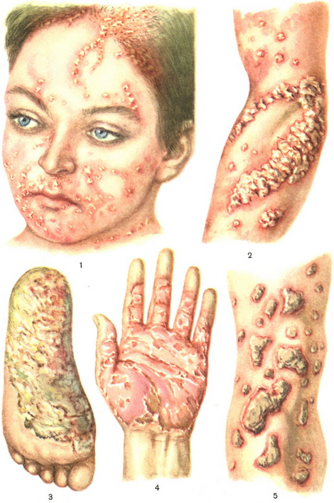 псоріаз фото