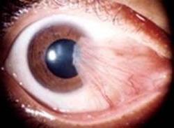 птерігиум (крилоподібний пліва)