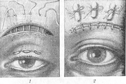 птоз операція