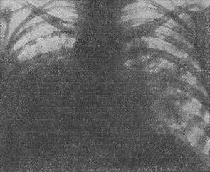 аденоматоз легень