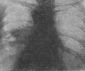 еозинофільний інфільтрат легенів