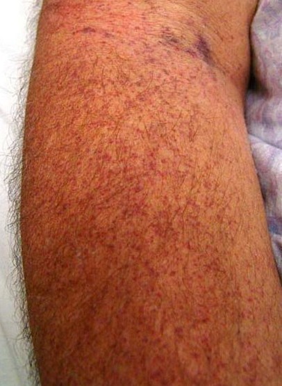 урпура тромбоцитопенічна