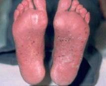 пустульозний бактерид