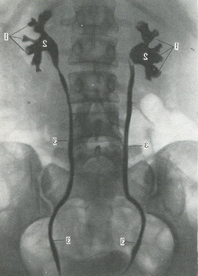 пієлографія з двостороннім контрастуванням