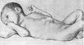 пілоростеноз