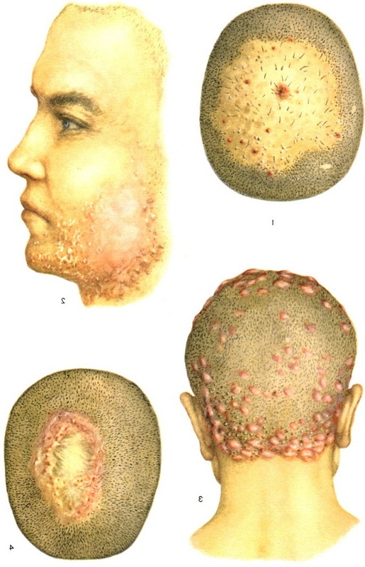 pyoderma
