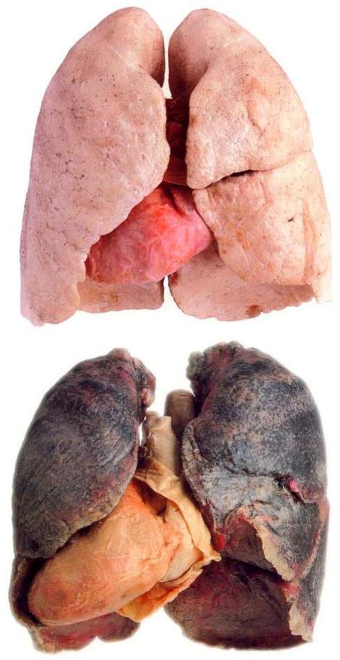 рак легенів фото