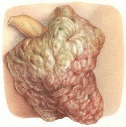 рак мошонки