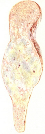 рак тіла підшлункової залози