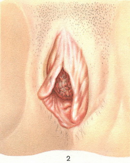 рак сечівника