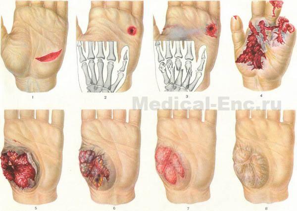 види загоєння ран