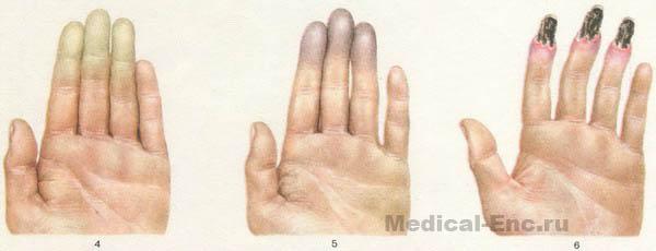 хвороба Рейно