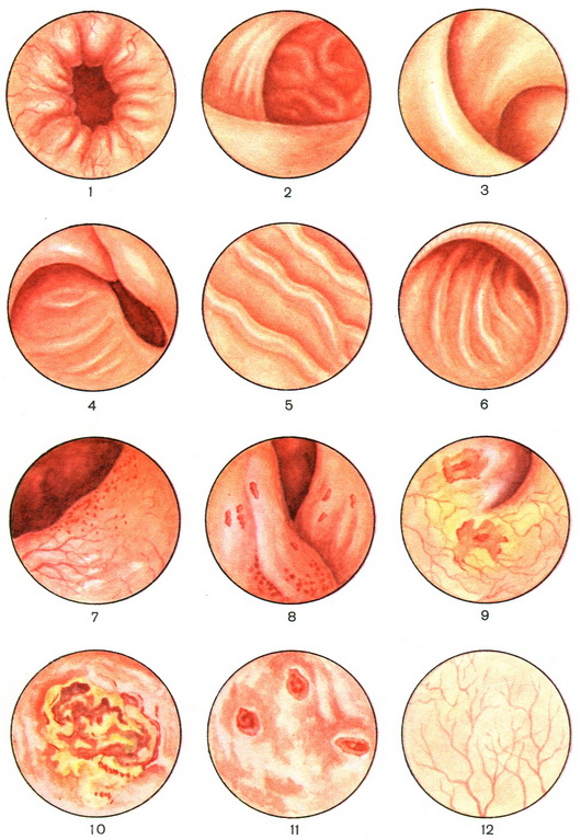 ректороманоскопія