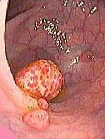 поліпоз прямої кишки