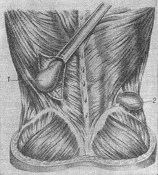 види поперекових гриж