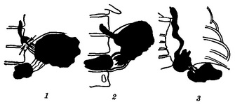 регургітація