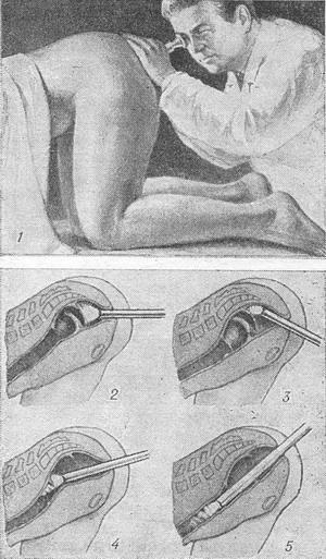 ректороманоскопія