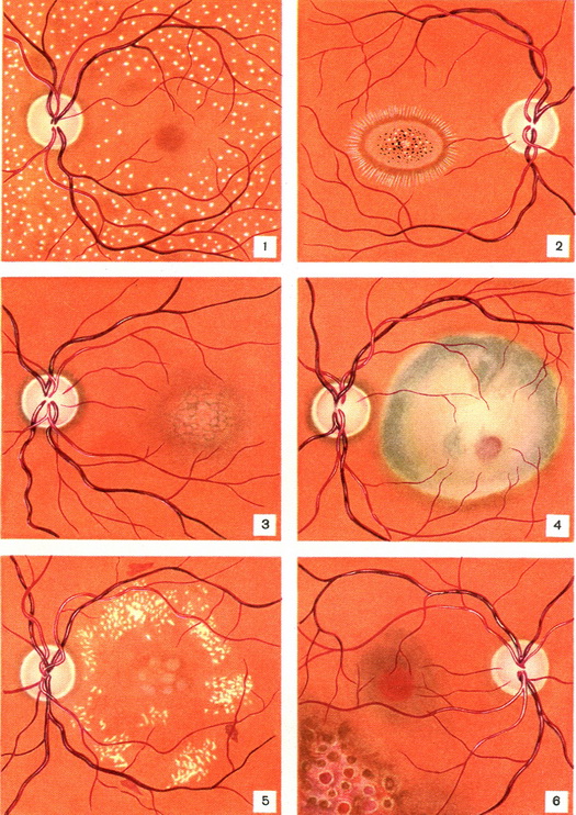 хвороби сітчастої оболонки