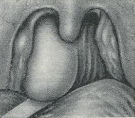 заглотковий (ретрофарингеальный) абсцес