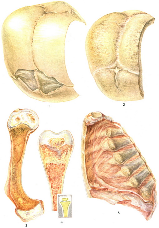 рахіт патологія кісток