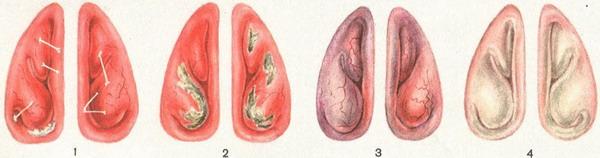 риніт (нежить)