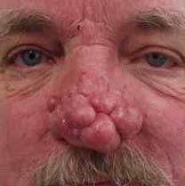 ринофіма фото