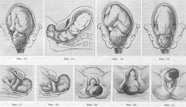 механізм і ведення пологів при потиличних передлежання