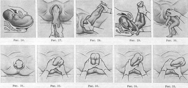механізм і ведення пологів при тазових передлежання