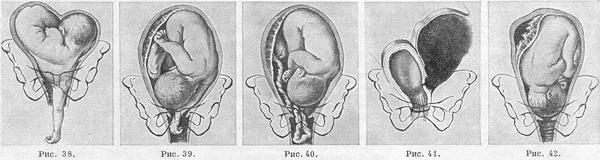 патологія пологів