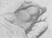 загрозливий розрив матки