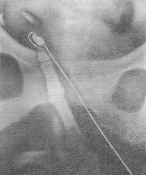 уретеролитоэкстракция