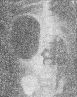 рентгенограма новонародженого з непрохідністю дванадцятипалої кишки