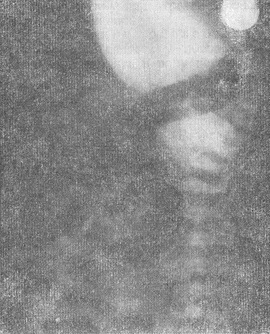 рентгенограма новонародженого з атрезією анального отвору