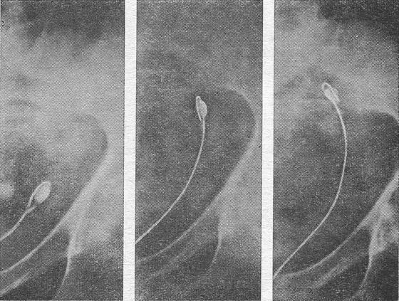 видалення каменя із сечоводу