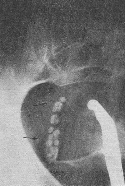 камені сечоводу рентген