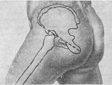 лінію Розера - Нелатона