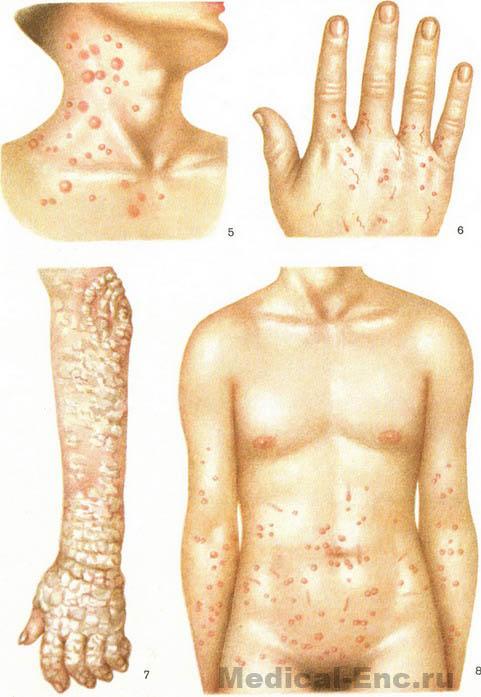 короста фото