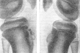 хвороба Шлаттера