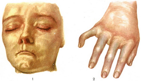 склеродермія фото