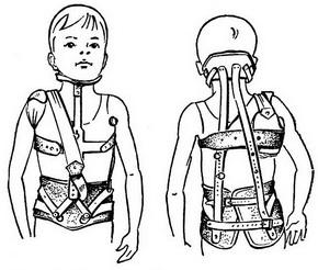 корсет для лікування сколіозу