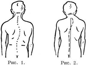 викривлення хребта