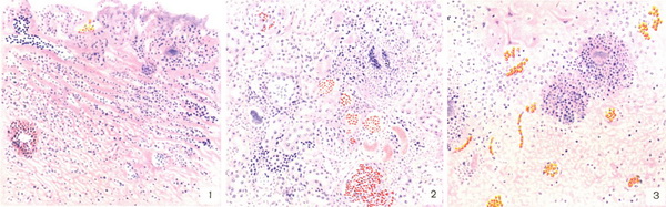 септикопіємії