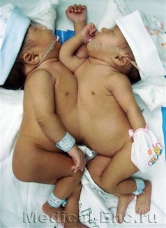 сіамські близнюки