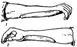 лонгет при пошкодженні суглобів
