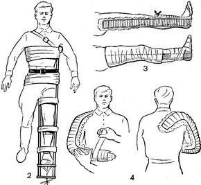 транспортна іммобілізація