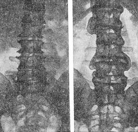 спондильоз (рентгенограми)