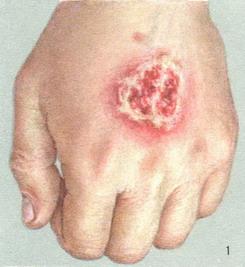 споротрихоз